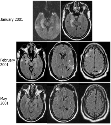 Follow-up MRI in patient 6. MRI FLAIR sequences obtained at different time points of symptom recurrence in patient 6. Note the discrete cortical areas of hyperintensity involving the medial and lateral right temporal region, right frontal lobe, left insular and left parietal and occipital lobes (arrows). Significant improvement was noted in the MRI obtained in May 2001, correlating with clinical improvement of the multifocal encephalitis.