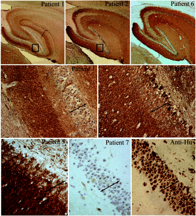 Immunohistochemical analysis of neuropil antibodies. Upper row: sagittal sections of rat brain immunoreacted with sera of patients 1, 2 and 6. Note that the three sera show intense reactivity with the neuropil of hippocampus. Patients 2 and 6 harboured the same novel neuropil antibody and abrogated the reactivity of each other in immunocompetition assays; patient 2 had an additional antibody reacting with a subset of neurons in the inner part of the dentate gyrus (shown at high magnification in the middle row). Middle and lower rows show at high magnification the reactivity of sera from patients 1, 2, 5 and 7 and a control anti-Hu. Compare the intracellular reactivity of sera 7 and anti-Hu with the predominant neuropil reactivity of sera 1, 2 and 5 that spare the nuclei and cytoplasm of neurons (except for serum 2 that reacts with a subset of cells). Note that serum 1 has identical reactivity to the serum of a control patient with radioimmunoassay-positive VGKC antibodies shown at low and high magnifications in Fig. 5 (slides mildly counterstained with haematoxylin; upper row ×5; middle and lower rows ×200).