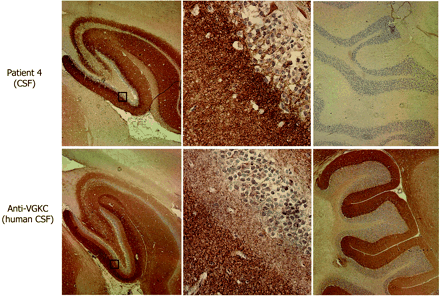Immunohistochemical comparison of the neuropil antibodies of patient 4 with human VGKC antibodies. Sagittal sections of rat brain immunoreacted with CSF of patient 4 and CSF from a control patient with VGKC antibodies determined with the α-dendrotoxin radioimmunoassay. Note the different patterns of hippocampal reactivity (left panels). The neuropil antibody of patient 4 preferentially reacts with the inner aspect of the molecular layer adjacent to the granular cells of the dentate gyrus, while the VGKC antibodies predominantly react with the outer aspect of the molecular layer distant from the granular cells. These differences are better demonstrated in the squares magnified in the middle panels. The neuropil antibody of patient 4 does not react with cerebellum, while VGKC antibodies react with the molecular layer of cerebellum (right panels). Slides mildly counterstained with haematoxylin. Magnification: left panels ×5; middle panels ×400, right panels ×10.