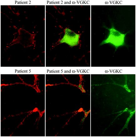 Double immunolabelling of hippocampal neuronal cultures with patients' sera and VGKC antibodies. Using rat hippocampal neurons, the antibodies from patients 2 and 5 (red, left panels) produce widespread labelling of the surface of neurons and dendrites without co-localization (middle panels) with VGKC antibodies (green, right panels). Note that in cultured rat hippocampal neurons, the VGKC antibodies predominantly label the proximal aspect of the neuronal processes and cytoplasm. Sera of 10 other patients with radioimmunoassay-positive VGKC, and monoclonal and polyclonal antibodies to Kv1.2 produced identical reactivity to the VGKC serum used here (data not shown). All panels ×800 (oil).