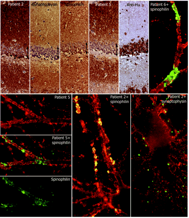 Comparative reactivity of patients' antibodies with synaptic and dendritic markers. Top row, first five panels: consecutive coronal sections of rat hippocampus reacted with the indicated antibodies. Note the intense and diffuse reactivity of all antibodies (except anti-Hu) with the neuropil of hippocampus, relatively sparing the cell bodies of the neurons of the dentate gyrus (arrows). Sections mildly counterstained with haematoxylin ×400. Other panels: single and double immunolabelling of neuronal cultures with sera of the indicated patients (red) and spinophilin (green) or synaptophysin (green). Note the predominant surface localization of the antigens targeted by all patients' sera; there is imperfect co-localization (yellow) with the segmental expression of spinophilin, and less frequent co-localization with synaptophysin. All panels ×800 (oil).