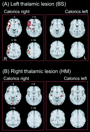 (A) Areas activated during caloric stimulation of the right or left ear in a single right-handed patient BS, who had a left posterolateral thalamic lesion (I < 0.001). Activations were found during caloric irrigation of the right ear—unaffected contralateral side (left panel); e.g. there was one large cluster in the posterior and anterior insula, inferior frontal gyrus, superior temporal gyrus, inferior parietal lobule, superior parts of the parietal lobule, hippocampus, posterolateral thalamus, putamen and medial frontal gyrus of the right hemisphere. There were only a few small activations within the left hemisphere in the anterior cingulate gyrus, the gyrus rectus and the occipital gyrus. Caloric irrigation of the affected ipsilateral left side (right panel) led to no significant activation within the right hemisphere and only minimal activation of the midbrain and basal ganglia within the left hemisphere. (B) Areas activated during caloric stimulation of the right or left ear in another right-handed patient HM with a right posterolateral thalamic lesion. During caloric irrigation of the ipsilateral affected side (left panel), activations were found in the hippocampus of the left hemisphere and bilaterally in the temporo-occipital (corresponding to MT/V5) and occipital visual cortex. Stimulation of the contralateral, unaffected side (right panel) led to activations of inferior parts of the insula and the adjacent temporal gyri bilaterally as well as of areas in the temporo-occipital and occipital visual cortex bilaterally. No activations were found in the multisensory vestibular cortex areas bilaterally during both stimulation conditions.
