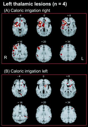 Activated areas during caloric stimulation of the right ear (A) or left ear (B) in patients with a left-sided posterolateral thalamic lesion (group analyses; each group n = 4; P < 0.001). (A) Activations were found for the left-sided lesions during right calorics (non–affected side) as large clusters in the posterior and anterior insula, inferior frontal gyrus, superior temporal gyrus, inferior parietal lobule, superior parts of the parietal lobule, hippocampus, paramedian thalamus and midbrain, nucleus ruber, putamen, medial and superior frontal gyrus, and cerebellar vermis of the right hemisphere. Activations of the left hemisphere were found in only the anterior cingulate gyrus and diagonal frontal gyrus. (B) Caloric irrigation of the affected left side was associated with smaller activations, predominantly within the left hemisphere, anterior and median parts of the insula, inferior frontal gyrus, putamen, caudate nucleus, superior frontal gyrus, medial temporal gyrus/inferior parietal lobule and lingual gyrus. Activations within the right hemisphere were only in the anterior cingulate gyrus and the cerebellar vermis.