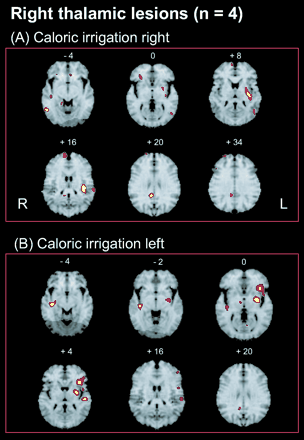 Activations in patients with right-sided lesions during caloric irrigation of the ipsilesional right side (A) were located in the posterior insula (transverse temporal gyrus), inferior frontal gyrus, hippocampus and medial temporal gyrus/medial occipital gyrus of the right hemisphere. Activations within the left hemisphere were found in the posterior insula and retroinsular region, putamen, inferior parietal lobule and medial temporal/medial occipital gyri. (B) Calorics of the left unaffected ear led to activations of the posterior and anterior insula, putamen, superior temporal gyrus, inferior frontal gyrus, medial frontal gyrus and medial temporal gyrus within the left hemisphere. In contrast, there were few activations within the right hemisphere, i.e. only in the inferior posterior insula, the midbrain and gyrus rectus.
