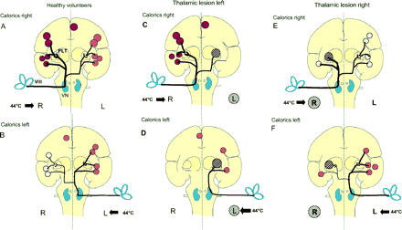 Schematic drawing of hypothetical ascending bilateral vestibular pathways from the vestibular nerve (VIII) via the vestibular nuclei (VN) of the medullary brainstem through the midbrain and posterolateral thalamus (PLT) to the temporo-insular region. Projections from the vestibular nuclei to the PIVC of the posterior insula are known to be stronger on the ipsilateral side (thicker line). Schematic depiction of the most consistent activations in the temporo-parieto-insular regions obtained from our data during caloric irrigation. The schematic coronal section through the insula summarizes all activations in the anterior-posterior direction from the frontal to parietal lobe. These coloured areas represent, from top to bottom, the anterior cingulum contralateral to stimulation, the inferior parietal lobule (BA 40), the posterior insula and retroinsular regions, the superior temporal gyrus (BA 22) and the inferior insula. The intensity of activation is represented by the intensity of the red colour and the size of the coloured areas. (A, B) These areas show, first, the strongest activations on the hemisphere ipsilateral to caloric irrigation (compare top and bottom) and, secondly, a hemispheric dominance of the right non-dominant hemisphere (top). The schematic transmission of vestibular input from the vestibular nerve via the vestibular nuclei to the posterolateral thalamus is based on the assumption that bilateral pathways cross in the upper pontine brainstem and the hypothesis generated by our study data that activation of the inferior insula bypasses the thalamic projection by direct ipsilateral and contralateral pathways. Schematic depiction of bilateral fronto-parietal and insular activations during caloric irrigation in posterolateral thalamic lesions left (C, D) and right (E, F), according to those obtained in healthy volunteers. In patients with a left thalamic lesion, caloric irrigation of the contralesional right ear (C) activated all ipsilateral multisensory vestibular cortex areas within the right hemisphere as depicted in normals (A) and the contralateral anterior cingulum. There were no vestibular cortical activations on the contralateral left hemisphere. During caloric irrigation of the ipsilesional left ear (D), the only activated cortical vestibular area was that of the left inferior insula. Thus, there was no significant activation of vestibular cortex areas contralateral to caloric irrigation in the right hemisphere, despite preserved ascending vestibular pathways on the right side. In patients with right thalamic lesions and ipsilesional caloric irrigation (E), there is a distinct activation of only the inferior part of the insula and a significant activation of the multisensory vestibular cortex areas of the left hemisphere via the preserved contralateral ascending pathways. Irrigation of the contralesional left ear (F) elicited a pattern similar to that of right ear stimulation.