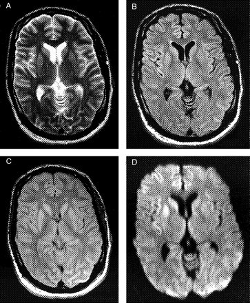 T2-Weighted (A), FLAIR (B), PD-Weighted (C) and DW (D) sequences of a patient with autopsy-proven sCJD. The MRI was rated as ‘typical for sCJD’ by all three observers. Scans show high signal in the caudate nucleus and putamen bilaterally. In the DW sequence (D) a predominance of the right striatum and additionally increased signal in the right frontal and insular cortex is discernible.