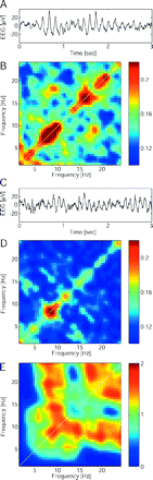 Inter-frequency relationships for the EEG signal recorded at the electrode FCz. (A) The raw EEG waveform of patient 10 is asymmetric in the sense that positive peaks are sharper than negative peaks. This triangular waveshape resembles the function sin2(x) and results in enhanced second-order phase coupling between the theta band oscillation and its overtone in the beta band for this patient. (B) Bicoherence averaged over the patient group shows second-order phase coupling in the diagonal and also between theta and beta bands. (C) In the raw EEG waveform of a healthy control, the asymmetry between positive and negative peaks is less pronounced. (D) Average bicoherence in the healthy control group lacks off-diagonal peaks. (E) Z-values for the comparison between bicoherence maps of the patient group and the healthy control group (Wilcoxon rank sum tests). Bicoherence tends to be higher in patients in the diagonal as well as for theta–beta coupling.