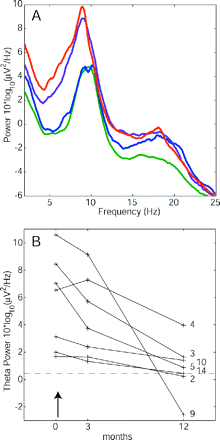 Reduction of EEG power after the therapeutic lesion CLT. (A) The average spectrum of a patient subgroup (n = 7) before surgery (red), after 3 months (violet) and after 12 months (blue) gradually approached that of the healthy control group (green). (B) The power level in the theta band (4–9 Hz) is plotted before (months = 0) and after surgery (↑). After 12 postoperative months, theta reduction was observed in all the seven patients (P < 0.02). Patient theta levels approached the average of the healthy control group (dashed line).
