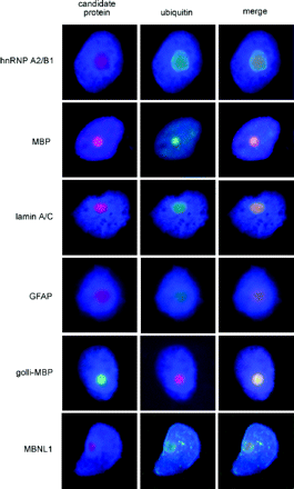 Double immunofluorescence staining of protein candidates identified by tandem MS analysis of purified inclusions, to assess co-localization of proteins with ubiquitin-positive inclusions. Immunostaining for various candidate proteins (left column); anti-ubiquitin immunostaining (centre column); and merged images demonstrating co-localization of candidate proteins with ubiquitin-positive inclusions (right column).