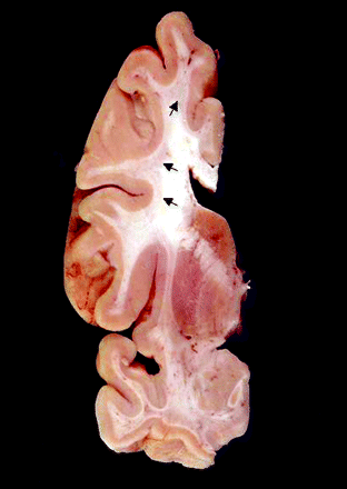 Coronal section of formalin-fixed brain (Case 7). This case showed severely affected cerebral white matter both grossly and microscopically. Involvement appears as subcortical regions of pale grey discolouration (arrows). These changes were present throughout the cerebral white matter. Note that periventricular white matter is spared.