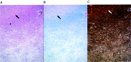 Cerebral white matter from Case 7, showing (A) gradations of spongiosis and parenchymal pallor in subcortical white matter. Note the lack of these changes around vessel (v). Arcuate fibres (a) in this view show little involvement (H&E stain, ×40). (B) Corresponding myelin loss is seen on LFP-PAS stain (×40). (C) Bielschowsky stain demonstrates axonal loss in the same area (×40). Grey/white matter junction is indicated by arrows.