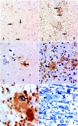 Astrocytic involvement in grey and white matter (Case 7) (A) Scattered, hypertrophied, protoplasmic astrocytes in cortical grey matter (arrows) (×100). (B) Subcortical white matter shows, by comparison, large numbers of dramatically enlarged, fibrillary astrocytes (arrows); granular deposits represent hypertrophied astrocytic processes (×100). (C) Neuronal (open arrowhead) and astrocytic (closed arrowhead) intranuclear inclusions in cortical grey matter (×400). (D) Hypertrophied fibrillary astrocyte in the white matter (×400). (E) Remarkably enlarged, inclusion-bearing (arrowhead) astrocyte in the subcortical white matter (×1000). (A–E) Paraffin-embedded tissue, GFAP immunostained. Note: LCA and CD68 immunostaining was negative. (F) Similar inclusion-bearing (arrowhead) astrocyte in resin-embedded white matter showing associated spongiosis/vacuolar change (v). Myelinated axons are also indicated (arrows). Formalin-fixed tissue was subsequently fixed in glutaraldehyde solution; methylene blue stain, ×1000.