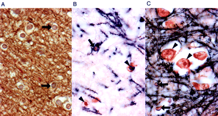 Examination of oligodendroglial nuclei in white and grey matter (Case 1) for the presence of intranuclear inclusions. (A) White matter, with many oligodendroglial nuclei (arrows), all devoid of inclusions. (B) Grey matter, demonstrating inclusions in astrocytic nuclei (arrowheads), but not in an oligodendroglial nucleus (arrow). Note the cytoplasmic staining of oligodendroglial cytoplasm for myelin basic protein (MBP); dark brown reaction product. (C) Cortical grey matter displaying a cluster of neurons with and without inclusions (arrowheads) and several oligodendroglial nuclei without inclusions (arrows). All sections were double-immunostained for MBP (dark brown) and ubiquitin (red stain) (×630).