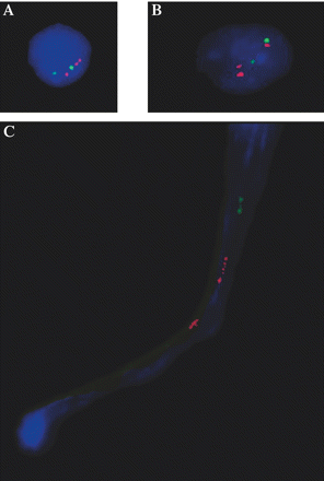 FISH analysis of an interphase nucleus (A and B) and a mechanically stretched metaphase chromosome of an APP genomic duplication patient of Family 1104 (C). Red signals indicate APP [BAC clones RP11-15D13 (A and C) or RP11-910G8 (B)] and the green signal indicates a 21q22.12 reference probe (RP11-451M12). (Interphase nuclei showed a slight degree of mechanical stretching due to cyto-centrifuging.)