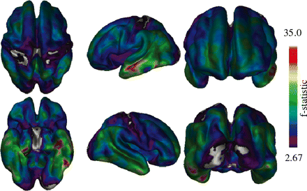 Vertex-by-vertex ANCOVA analysis of thickness data. Most regions of the brain show significant differences with the exception of the occipital lobe and some areas of the pre- and post-central gyri.