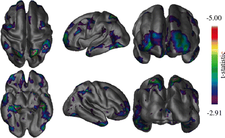 Vertex thickness differences between the healthy elderly and MCI groups. The most significant difference seen is in the left medial temporal region. The frontal and posterior parietal areas also show differences in a more bilateral fashion.