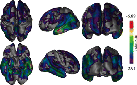 Differences between the MCI and Alzheimer's disease groups. Differences in the temporal regions are shown bilaterally as well as in the frontal lobe regions. The most pronounced differences clearly occurring in the left lateral temporal area.
