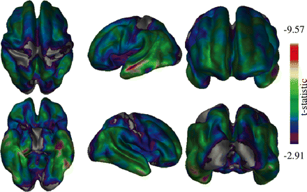 Differences between healthy elderly and Alzheimer's disease subjects across the cortex. Clear medial and lateral temporal lobe differences are present bilaterally. Occipital, primary motor and primary sensory cortices show the least significant differences.