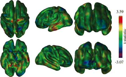 Assessment of thickness differences between the transition from healthy elderly to MCI and from MCI to Alzheimer's disease. Darker (purple/blue) areas represent areas where thickness changes from healthy elderly to MCI are larger than those from MCI to Alzheimer's disease, while lighter (red/yellow) areas represent the opposite. Note that results do not reach statistical significance, but interesting trends are apparent.