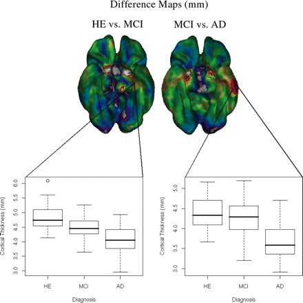 An illustration of thickness differences between the medial and lateral temporal lobe areas. The graphs illustrate the age-corrected thickness differences between groups for vertices on the medial and lateral left temporal areas. On the medial side, the cortex appears to thin gradually between the different conditions, while laterally a much more pronounced difference is seen between the MCI and Alzheimer's disease groups, than between the healthy elderly and MCI groups.