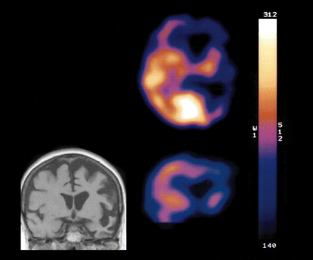 MR (coronal section) and SPECT scan (transaxial and coronal sections) of F337 proband, showing asymmetrical atrophy and impaired tracer uptake in left hemisphere.