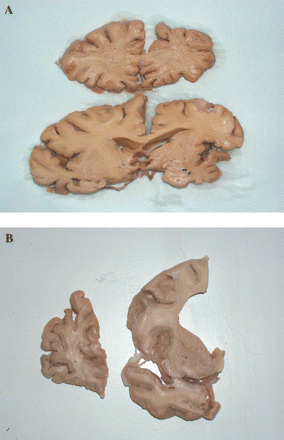 (A) Shows coronal sections of brain of proband of F337 at level of frontal lobe (upper) and mid temporal lobe (lower). Note the markedly asymmetric atrophy affecting left side of brain (shown on right) preferentially. The white matter is softened and fragmentary on left side, both within frontal and temporal lobes. The hippocampus and amygdala are mildly atrophied, as are basal ganglia. (B) Shows coronal sections of brain of proband of F53 showing severe atrophy of frontal lobe and moderate atrophy of temporal lobe and basal ganglia. Again, the deep white matter of the frontal lobe is soft and fragmentary.