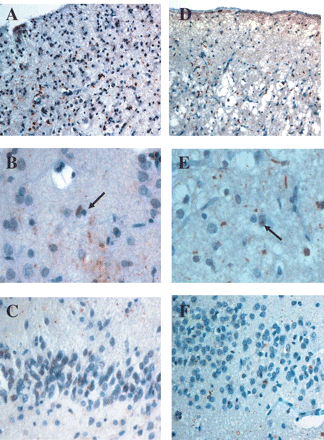 Ubiquitin pathology in the probands of F337 (A–C) and F53 (D–F). In both patients there is only a moderate number of ubiquitin-positive neurites and neuronal cytoplamic inclusions in temporal cortex (A and D). Occasional neuronal nuclear inclusions (arrowed) are present in both (B and E). There are only few, rather granular, ubiquitin cytoplasmic inclusions in granule cells of the dentate gyrus of the hippocampus (C and F). Ubiquitin immunoreactivity–haematoxylin, magnification ×200 (A and D), ×600 (B and E), ×300 (C and F).
