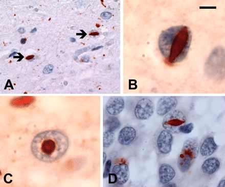 (A and B) All cases with proven PGRN mutations had lentiform ub-ir neuronal intranuclear inclusions (NII) in the neocortex and striatum (arrows). (C) Round NII likely represent lentiform inclusions viewed in cross-section. (D) NII were occasionally seen in other regions such as the hippocampal dentate granule cells. Ubiquitin immunohistochemistry. (A) Scale bar = 40 μm, (B and C) scale bar = 4 μm and (D) scale bar = 20 μm.