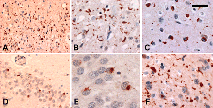 In addition to NII, all cases with PGRN mutations showed similar pathological changes (Table 2). (A–C) In layer II of the frontal neocortex, there were moderate-to-numerous ub-ir neurites (B) and neuronal cytoplasmic inclusions (NCI) (C). Most NCI were well-defined and had a curved or oval shape (C). (D and E) NCI in hippocampal dentate granule cells were variable in number and most had a granular appearance. (F) Numerous ub-ir neurites were present in the striatum. Ubiquitin immunohistochemistry. (A) Scale bar = 66 μm, (B and C) scale bar = 33 μm, (D) scale bar = 50 μm, (E) scale bar = 13 μm and (F) scale bar = 33 μm.