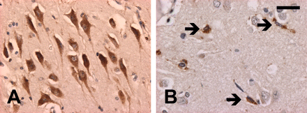 In all cases, PGRN immunohistochemistry demonstrated granular cytoplasmic staining in a subset of pyramidal neurons, including the hippocampus (A) and in activated microglial cells (arrows) (B). In cases with PGRN mutations, there was no staining of neurites or neuronal inclusions in the neocortex (B). PGRN immunohistochemistry. (A and B) Scale bar = 23 μm.