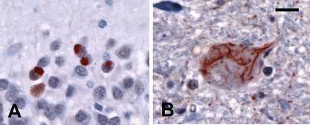 In cases without mutations or NII, hippocampal NCI more often had a solid, rather than granular, appearance (A). All cases with clinical MND-dementia had characteristic ub-ir cytoplasmic inclusions in lower motor neurons (B). Ubiquitin immunohistochemistry. (A and B) Scale bar = 15 μm.