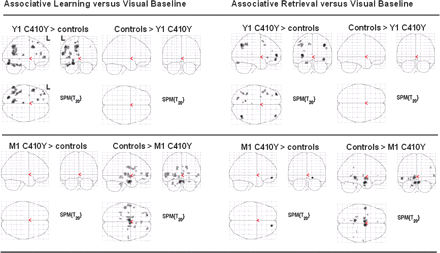 Brain activity differences between each PSEN1 C410Y mutation carrier and the controls for the contrast Run 1 of associative learning versus visual baseline and the contrast associative retrieval versus visual baseline. Upper panel: The young mutation carrier exhibited areas of enhanced activity. Lower panel: The middle-aged mutation carrier exhibited areas of reduced activity.