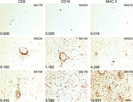 Range of staining intensities of cell type-specific markers. Representative images of staining with monoclonal antibodies to CD8 (T cell), CD16+ (infiltrating macrophages) and MHCII (antigen presenting cells) of sections showing low, intermediate and high frequencies of target cells. The patient identifier is shown in the top right-hand corner of each panel. The total area of the section stained for each marker quantified by automated Image-Pro Plus image analysis is shown in the bottom left-hand corner of each panel. The scale bar represents 50 microns.