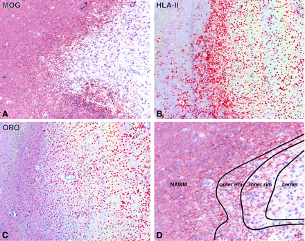 Definition of micro-locations of foamy macrophages within active demyelinating multiple sclerosis lesions. (A) Extensive demyelination in post-mortem brain tissue of a multiple sclerosis patient as shown by the absence of MOG immunoreactivity in the lesion. Magnification ×8 (B) Strong HLA-II immunoreactivity is present on foamy macrophages throughout the lesion. Magnification ×8. (C) Foamy macrophages contain abundant neutral lipids as shown by ORO staining. Magnification ×8. (D) Based on the degree of demyelination as well as presence and size of ORO+ and HLA-II+ foamy macrophages arbitrary lines were set dividing NAWM, outer rim, inner rim and centre of the lesion. Magnification ×16.