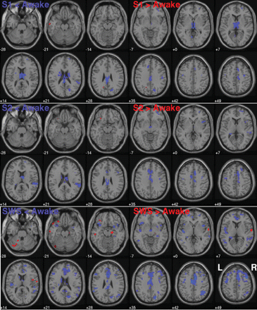 Transverse slice view: The coloured areas represent BOLD-related activations and are superimposed onto a T1-weighted MRI of a male individual as supplied with SPM2. Blue denotes less activation during the sleep stages and red more activation during sleep stages. The first row shows the comparison ‘Awake versus Sleep stage 1’, the second ‘Awake versus Sleep stage 2’ and the third row ‘Awake versus SWS’ (P = 0.001, k = 25, not corrected).