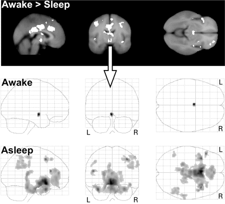 First row: Contrasting the BOLD response of resting awake with NREM sleep (S1 to SWS) with less smoothed data (4 mm FWHM) to enhance sensitivity for subcortical regions. We extracted the averaged hypothalamic time series (arrow) and modelled them as regressors of interest in a second SPM analysis to determine functional connectivity between the awake and sleeping conditions. Second and third rows: Functional connectivity map with hypothalamic regions (volume 5 × 10 × 3 mm at MNI coordinates −2, −10, −10). The grey coloured regions (Table 5) within the glass brains denote functional connectivity of hypothalamic activity during the resting awake state (shortly before sleep onset) and during NREM sleep when hypothalamic activity was decreased compared with the awake state.