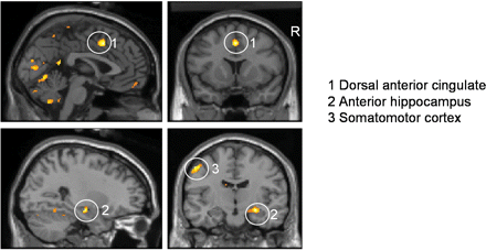 Regional brain activity to paired CS + arm in SCI patients and controls. The delivery of shock to the arm (coupled with the CS + arm stimulus) enhanced regional brain activity within dorsal cingulate and medial temporal components of the pain matrix in both patients with SCI and controls. Common responses to CS + arm (paired) trials also were observed within an extrastriate visual region, medial temporal lobe (right anterior hippocampus), dorsal anterior cingulate cortex, with a common region of somatomotor cortex. The location of common group activations within dorsal anterior cingulate, medial temporal lobe and somatomotor cortex are illustrated on parasagittal and coronal sections of a normalized template brain scan.