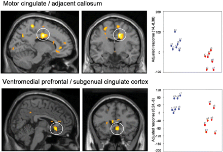 Conditioning-related activity: differences between controls and SCI patients. Conditioning-related activity represents the difference between responses to CS + and CS – stimuli (i.e. learned threat–safe). We tested for group differences in brain activity between SCI patients and controls during conditioning of faces to the CS + arm: controls showed activation of midline regions (posterior cingulate, motor cingulate, subgenual cingulate and ventromedial prefrontal cortex). SCI patients (in red on the scatter plots), compared to controls (in blue on the scatter plots), showed decreased activity during threat (CS + arm unpaired versus CS – arm), mainly in midline regions including posterior cingulate, motor cingulate, subgenual cingulate and adjacent ventromedial prefrontal cortex. Group differences in regional activity are plotted on parasagittal and coronal sections of a template brain next to scatter plots of the parameter estimates (arbitary units, proportional to % signal change) for controls and SCI patients.