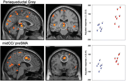 Conditioning-related activity: differences between SCI patients and controls. SCI patients (in red on the scatter plots), in contrast to controls (in blue on the scatter plots), demonstrated enhanced brain activity to the conditioned threat [CS + arm (unpaired) > CS – arm] within dorsal anterior cingulate cortex and periaqueductal grey (PAG), regions commonly activated by pain. Greater activity was also observed within visual cortices of superior temporal and lateral occipital gyri that encode salient face stimuli and expression. These findings imply a hypersensitivity of brain responses within the central pain matrix and affective sensory representation to predictors of aversive stimulation. Group differences in regional activity are plotted on parasagittal and coronal sections of a template brain next to scatter plots of the parameter estimates (arbitary units, proportional to % signal change) for controls and SCI patients.