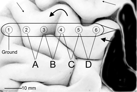 Schematic diagram of electrode strip placement on the cortex with respect to injury and gyri. Electrode 6 is positioned over viable cortex next to contused tissue (black area). The visible part of the strip is placed along a gyrus and slipped under the edge of cut dura and bone (not shown). Thus, Electrodes 1–4 are usually not visible. Signals from Electrodes 2–6 are amplified in a differential montage to derive data channels A to D. Thick arrows indicate possible course of a CSD along a gyrus, curving around sulci and reaching the electrode strip at different angles. In this example, the time required for the accompanying SPC to get from Electrodes 4 to 3 will be long, resulting in a low apparent velocity compared with Electrodes 5–4. Thin arrows indicate how a CSD spreading from another part of the lesion may eventually reach the electrode strip from the other end.