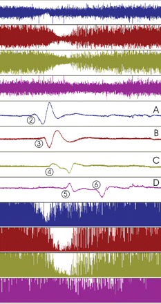 Recording of CSD in the injured human cortex over a period of 40 min (Patient no. 4). Upper four traces show the ECoG recorded in a differential chain from five electrodes (full scale 1 mV). A 50–80% reduction of the ECoG amplitude spreads from Channel A to C, while a 25% reduction of amplitude is seen in Channel D. Middle four traces show the same curves upon integration of the signal (full scale 4 mVs) to enhance the slow potential changes. Each depression in the upper traces is accompanied by a stereotyped baseline change reflecting an SPC. Electrode numbers are indicated to mark the onset of depolarization at that particular electrode as evidenced by phase reversal. Thus, the SPC occurring exclusively in Channel A compares to a depolarizing event at Electrode 2 alone, while a phase reversal between Channels A and B corresponds to an event at Electrode 3, etc. Lower four traces show the power of the 0.5–70 Hz band of the ECoG signal [full scale 0.03 mV2 (Channels A and D) or 0.12 mV2 (Channels B and C)]. The traces are amplified a little out of range to visualize loss of amplitude. The reduced activity of Channel D is better appreciated here than in the raw ECoG signal of the upper traces.