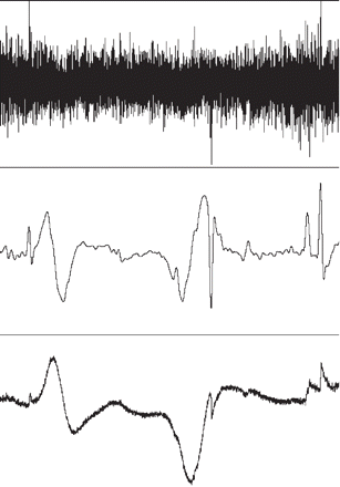Low-pass filtering versus integral: 20-min recording from Patient no. 4. (Upper and lower traces are details from Fig. 2, only Channel D is shown here). Upper trace, baseline changes of the raw ECoG signal (full range 1 mV) are hardly visible. Middle trace shows a 0.05 Hz low-pass filtering of the upper trace, full range 0.1 mV. Two SPCs are readily visible, but so are other deflections due to baseline noise. Lower trace shows the time-integrated signal (full range 3 mVs). Compared to the low-pass filtered trace, abrupt baseline noise is much less conspicuous. The initial electronegative part of the two SPCs is more pronounced due to the integrating process that reverses the differentiating effect of the AC-filtering during recording.