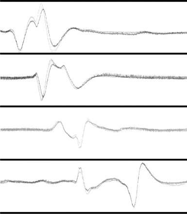 Three sets of 22-min recordings of integrated ECoG signal from three consecutive episodes of CSD (Patient no. 4). The figure illustrates that the ECoG signals for the same patient were stereotyped as indicated in this figure by superimposing traces from three different CSD episodes.