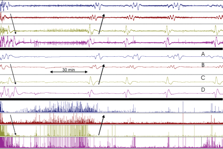 Three hour recording of ECoG from Channels A to D (Patient no. 9). The three sets of traces represent the same period (same setting as in Fig. 2): upper four traces show the unfiltered signal (full scale 3 mV). Middle four traces show the integrated signal (full scale 100 mVs). Lower four traces show the power of the 0.5–70 Hz band of the signal (full scale: 0.05 mV2). Baseline ECoG activity showed burst-suppression pattern: 2 s bursts and 10–30 s suppressions, amplitude 300–1000 μV. Initially, a CSD spreading from Channel A to D depressed this ECoG activity for 30–40 min. The CSD was accompanied by SPCs and spread from Channels B to D at a velocity of 2–3 mm/min (thin arrows). After ∼1 h another CSD accompanied by SPCs spread from D to A (thick arrows). This time, the ECoG activity did not recover. After 29 min, SPCs spread from channel D to A with exactly the same time sequence and shape as detected during the last CSD. The ECoG remained depressed indicating compromised metabolism. The event was therefore classified as a PID. Two stereotyped PIDs followed after intervals of 32 and 39 min. Just before the last of these PIDs slight recovery of ECoG in Channel D was noticed (lower right). During 5 h a total of 21 stereotyped PIDs were recorded. These PIDs were either similar to those in the figure or spread in the direction A to D in a second stereotyped pattern.