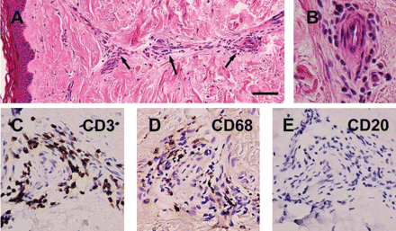 Cutaneous vasculitis in systemic lupus erythematosus. Paraffin-embedded sections were stained with haematoxylin–eosin (A and B). Adjacent sections were immunostained with markers: CD3 for T cells (C), CD68 for macrophages (D) and CD20 for B cells (E) in brown, and counterstained with haematoxylin. (A and B) Section shows marked perivascular infiltration (arrows) around dermal vessels. (C–E) Inflammatory infiltrate is composed of cells positive for CD3 and CD68, but negative for CD20. Scale bar = 50 µm in (A), 250 µm in (B) and 200 µm in (C–E).