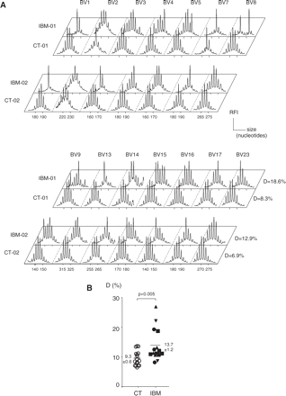 Immunoscope analysis of the T-cell repertoire in IBM patients and age-matched controls. The T-cell repertoire was studied in 17 IBM patients and 17 age-matched controls by analysing TCR-B CDR3 length distributions using immunoscope in 14 BV families. (A) Example of immunoscope profiles in IBM-01 and IBM-02 patients and two age-matched controls. T-cell clonal expansions manifest as a distribution skewed by the presence of larger peaks that accumulate above the Gaussian-like background of polyclonal T cells. (B) Quantitative analysis of T-cell repertoire perturbations. Average perturbation (D values) that reflect the level of repertoire perturbation are given for each IBM patient (black symbols) and controls (open symbols). There was no correlation between D value of IBM patients and their level of inflammation in the muscle biopsy (up triangle, grade 1; square, grade 2; down triangle, grade 3; circle, not done). Numbers are mean ± SEM for each group.
