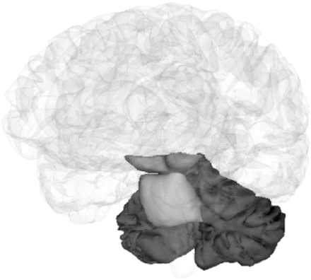 Regional segmentation demonstrating midbrain, pons and cerebellar volumes. For all ROI analysis, tissue boundaries were defined using the MIDAS software tool (Freeborough et al., 1997) with two orthogonal views available. Midbrain: The superior cut-off was taken as the upper border of the midbrain tegmentum in the mid-sagittal slice and the inferior border at the superior border of the pons in the mid sagittal slice. The posterior and anterior borders were defined by the brain tissue/CSF boundary (interpeduncular cistern anteriorly). Care was taken to include the quadrigeminal plate. Pons: The superior border was taken as a horizontal line extending posteriorly from the superior pontine notch. The inferior border was taken at the level of the inferior pontine notch. The anterior and lateral borders are clearly defined by CSF and the posterior border by the fourth ventricle. Cerebellum: segmentation included tissue in the cerebellar peduncles where it clearly connected with the cerebellar hemispheres. The anterior cut-off is taken as the most anterior slice to include cerebellar tissue. In all cases, care was taken to exclude all non-brain tissue.
