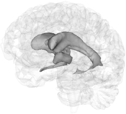 Regional segmentation demonstrating lateral and third ventricle volumes. Third ventricle: the anterior border of the ventricle was placed at the anterior commissure in the mid-sagittal section and the posterior border as the splenium of the corpus callosum. Care was taken to exclude voxels within the aqueduct of Sylvius. Lateral ventricle: a protocol for segmentation of the lateral ventricle has been described in detail previously (Dalton et al., 2002).