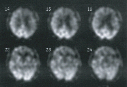 Brain perfusion single photon emission computed tomography (SPECT) of FTLD patient DR31.1 four years after onset of the disease showing relative bilateral frontal and temporal hypoperfusion, with left more pronounced than right.