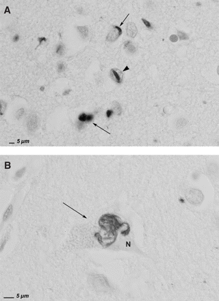 Ubiquitin immunohistochemistry of superior frontal gyrus of FTLD patient DR31.1. (A) The arrowhead points towards an ubiquitin-positive cat eye-shaped intranuclear inclusion. The arrows show ubiquitin-positive structures in neuronal perikarya. (B) The arrow shows a filamentous, tortuous ubiquitin-positive structure in the perikaryon of a neuron, the nucleus being indicated by the letter N. (Scale bar = 5 μm).